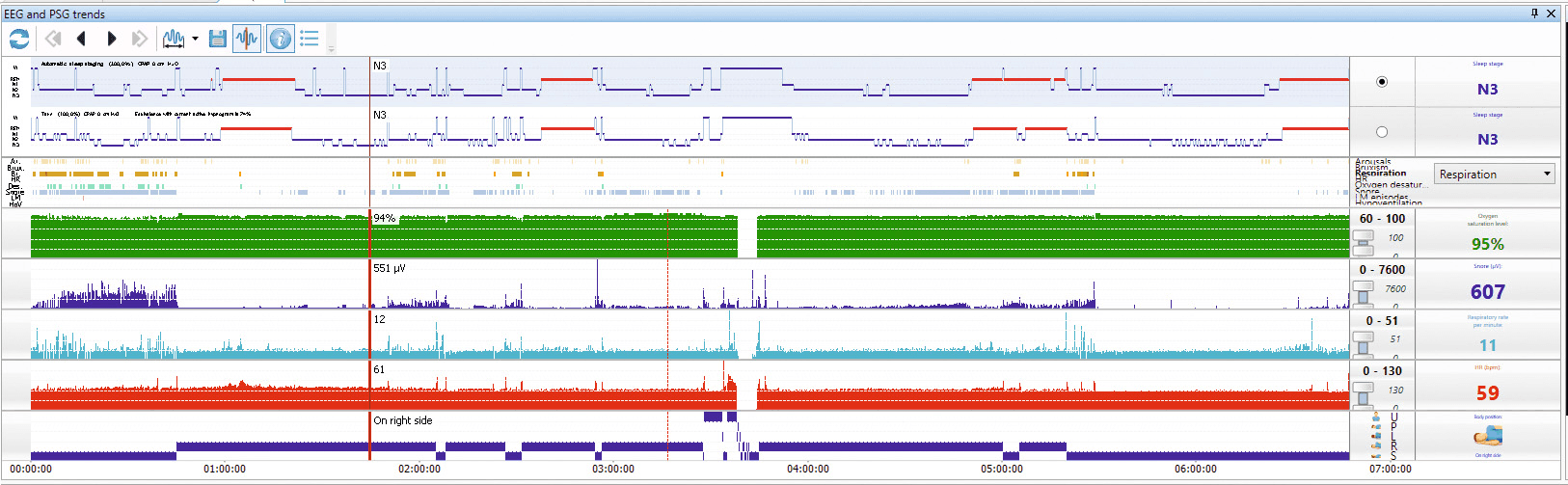 Neuron-Spectrum-AM/PSG (Loại I)